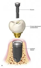 Screw Retained vs Cement Retained Implant Crowns