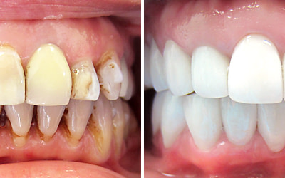 Rediscover Your Smile: Full Mouth Rehabilitation in Chennai