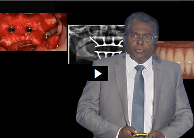 Dr.Gunaseelan Rajan: To graft or not to graft?