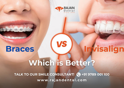 Top Benefits of Choosing Invisalign Over Braces
