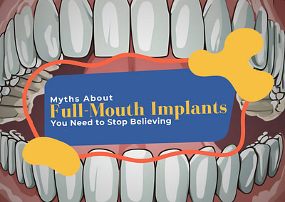 Myths About Full-Mouth Implants You Need to Stop Believing