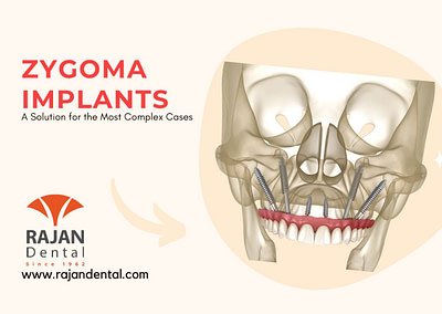 Zygoma Implants: A Solution for the Most Complex Cases