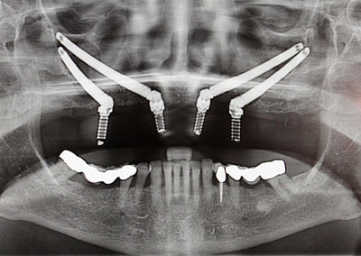 The Revolutionary Zygoma Implants at Rajan Dental