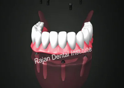 Treatment Timeline for All on 4 / Zygomatic Implants