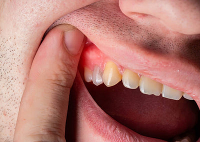 How to Manage Bleeding Gums