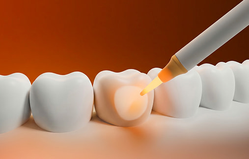 teeth-whitening
